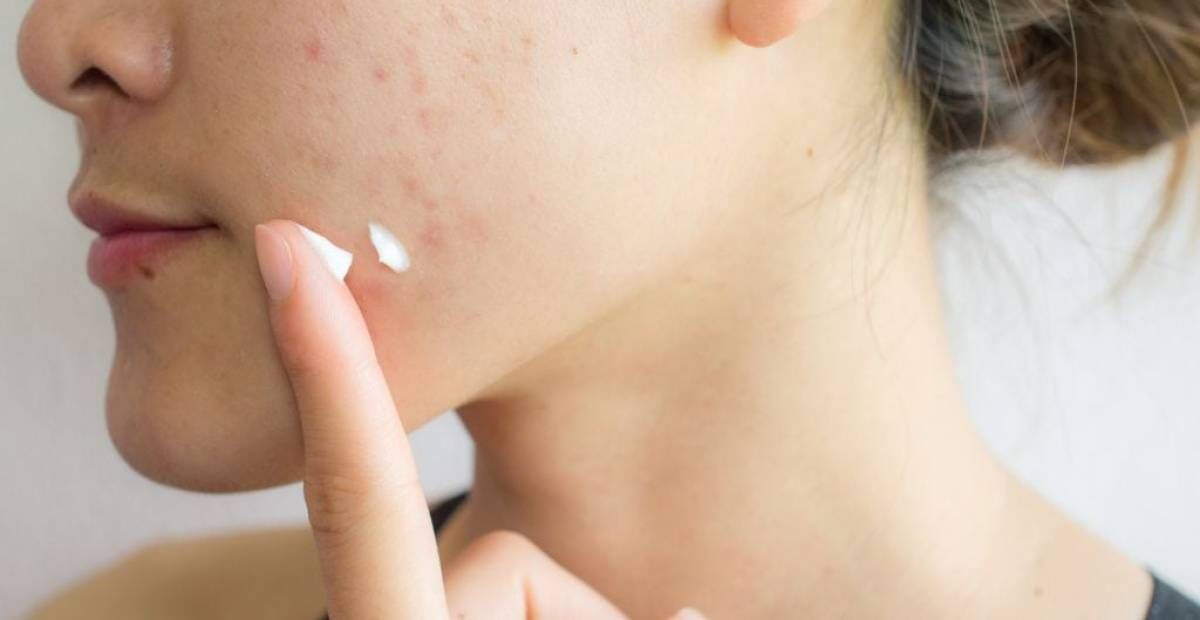 Sivilceli Ciltler İçin Nemlendirici Seçerken Nelere Dikkat Edilmeli?